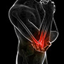  Elbow Arthritis 