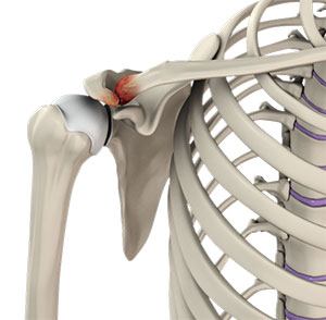 Acromioclavicular (AC) Joint Osteoarthritis