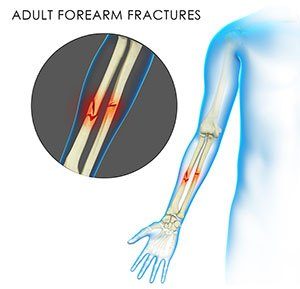  Adult Forearm Fractures 