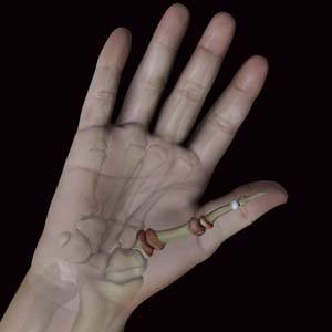  Arthritis of the Thumb 