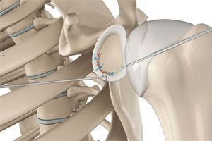  Arthroscopic Bankart Repair 