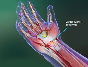  Carpal Tunnel Syndrome 