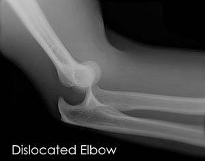  Elbow Dislocation 