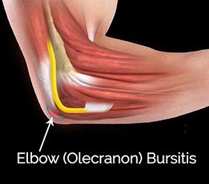  Elbow (Olecranon) Bursitis 