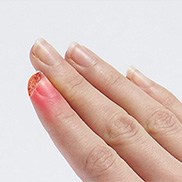  Fingertip Injuries 