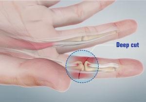 Flexor Tendon Injuries