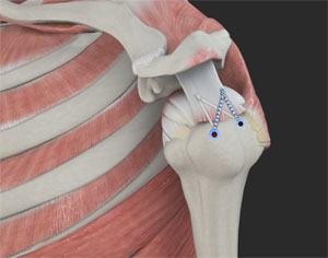  Rotator Cuff Repair 