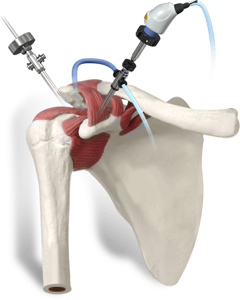 Arthroscopic